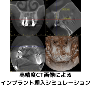 インプラントシミュレーション