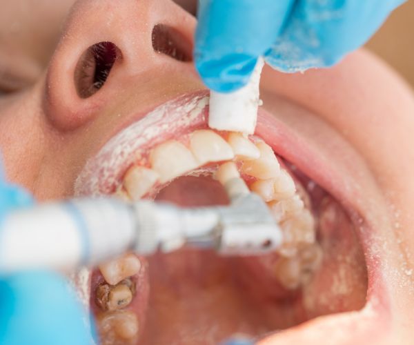 予約・クリーニング