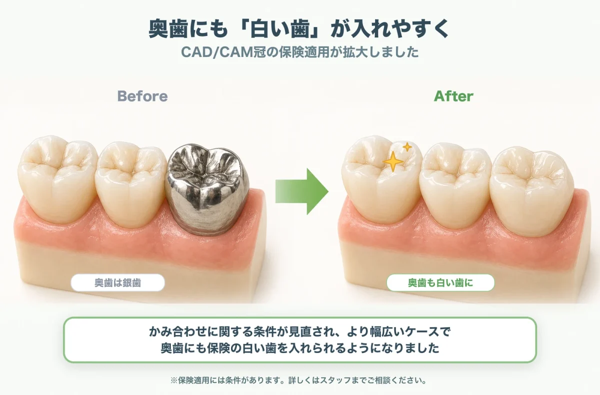 CAD/CAM冠適応