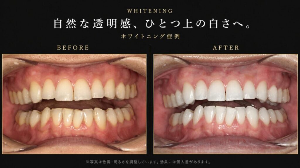 ホワイトニング術前術後