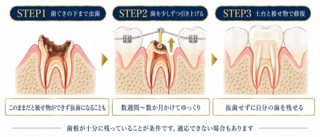 エクストリュージョン法の3ステップ図解(歯ぐきの下の虫歯→引き上げ→ファイバーコアの土台と被せ物)