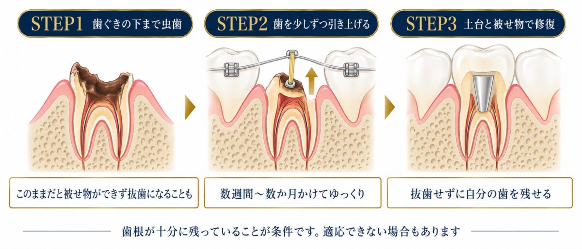 エクストリュージョン法(矯正的挺出)で歯を引き上げて被せ物で修復する3ステップの図解|日立市 こばやし歯科クリニック