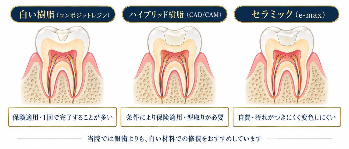 白い樹脂(コンポジットレジン)・ハイブリッド樹脂・セラミックの詰め物の図解|日立市 こばやし歯科クリニック