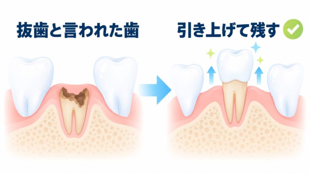 抜歯と言われた歯を引き上げて残すエクストリュージョン法のビフォーアフター図解