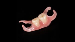 ノンクラスプデンチャー(金属のバネを使わない部分入れ歯)の構造イメージ